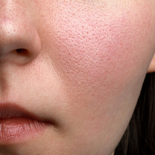 Dilated pores make it harder to keep your skin clear.