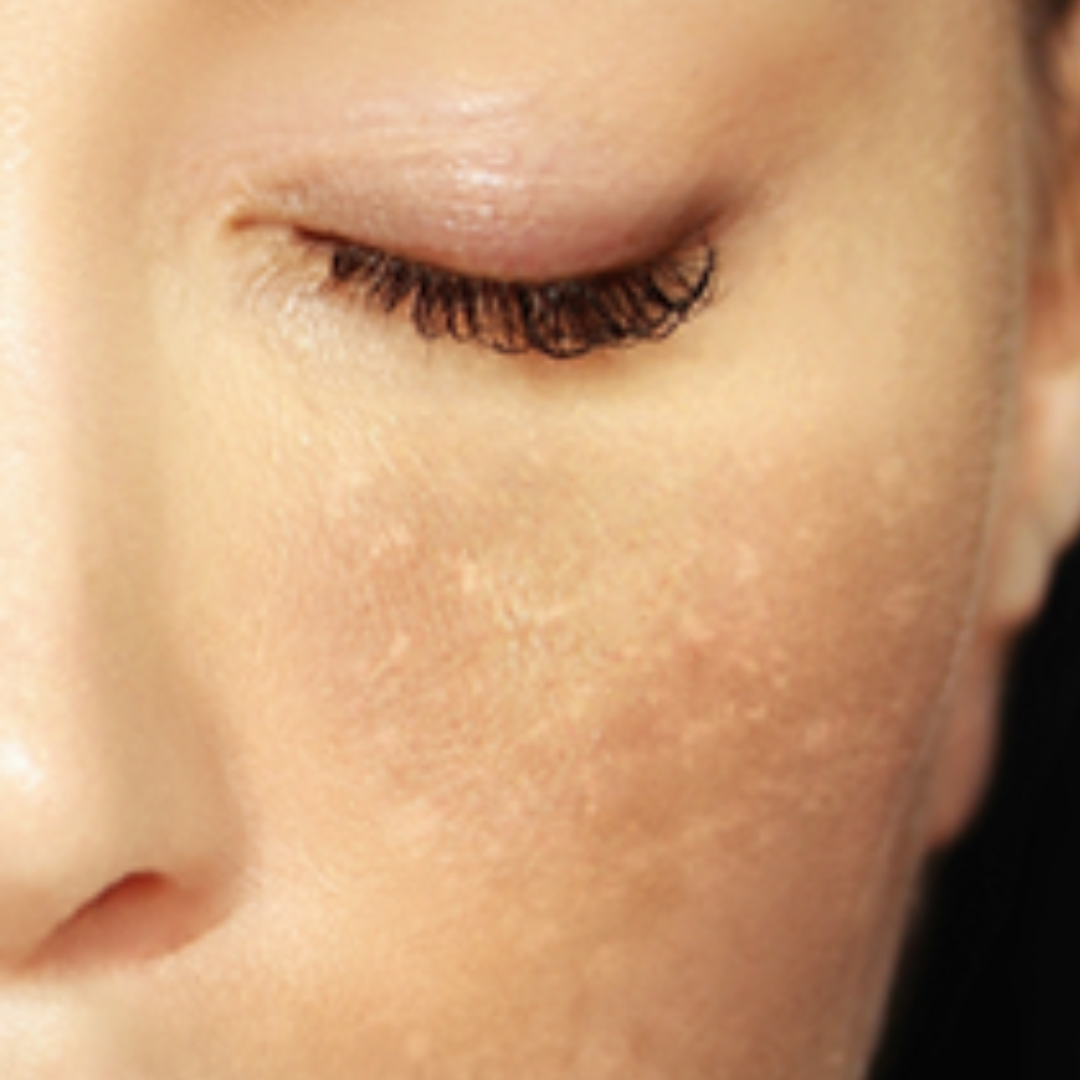 Close up on woman's closed eye and cheek with dark spots on it