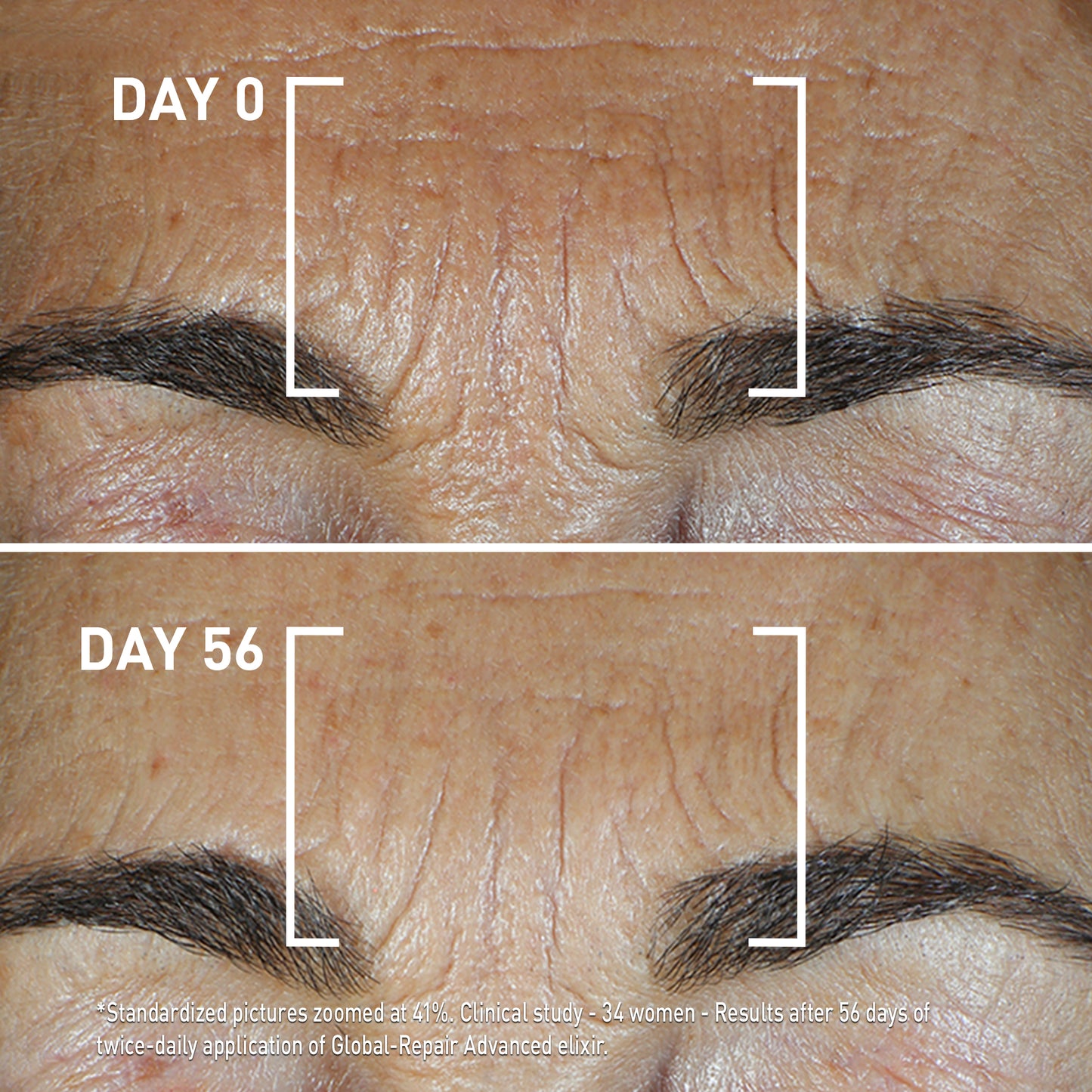 Day 0 and Day 56 showing reduced wrinkles after using FILORGA GLOBAL-REPAIR ADVANCED ELIXIR