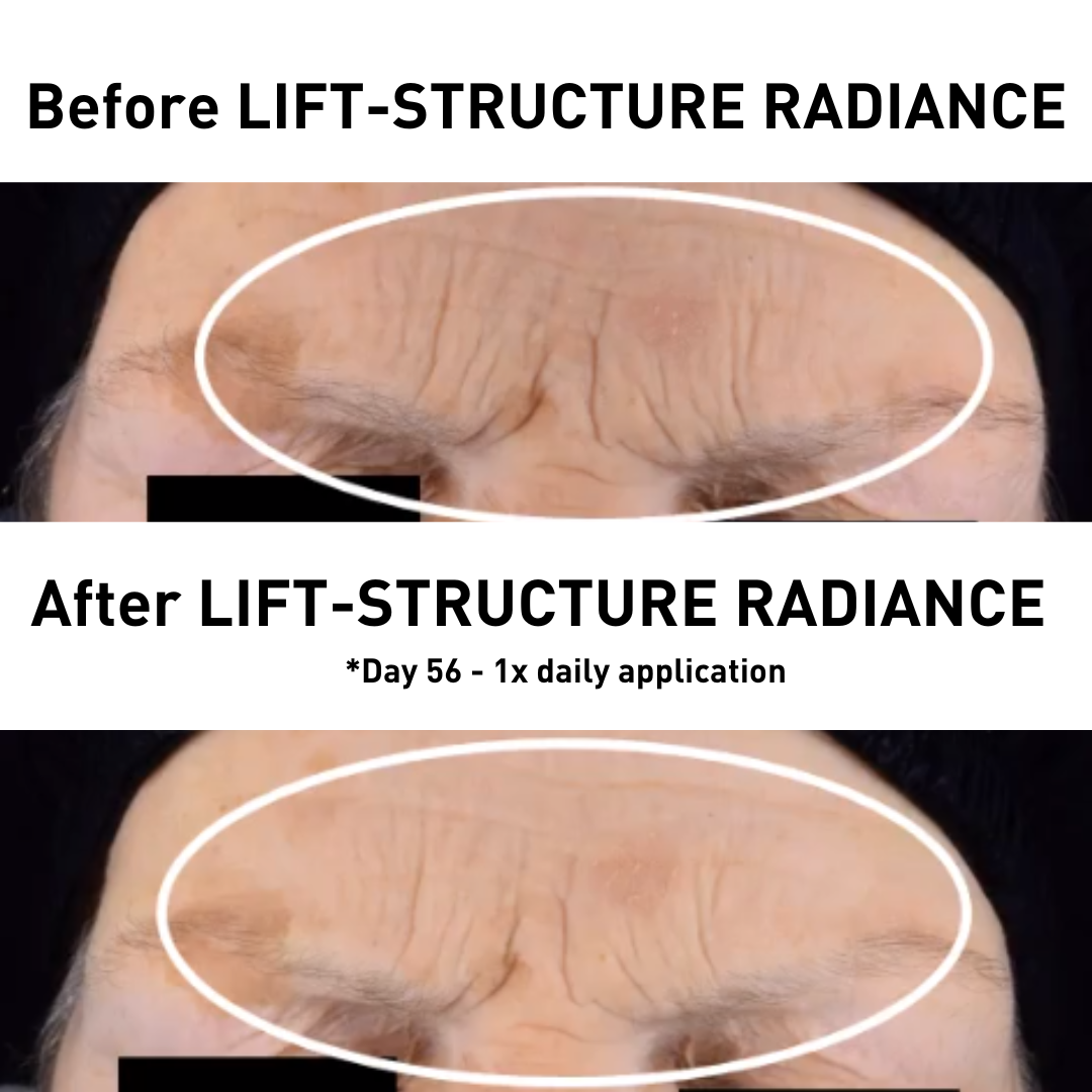 Forehead Before and After LIFT-STRUCTURE RADIANCE after 56 days of 1x daily application